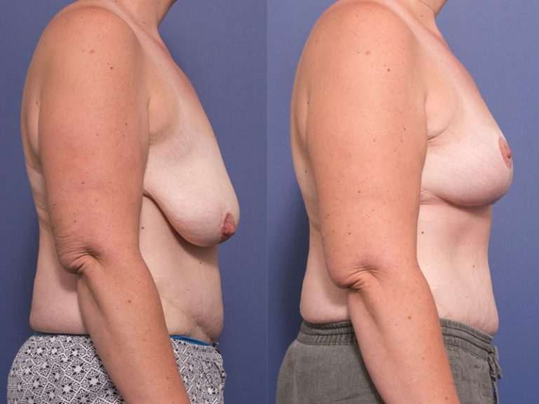 Breast Lift before and after 6C, Dr Peters