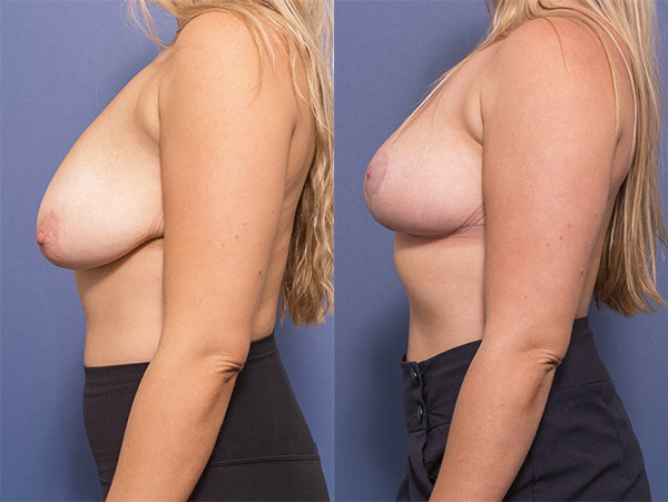 Before and after surgery, Bilateral Breast Reduction 2C, Dr Peters