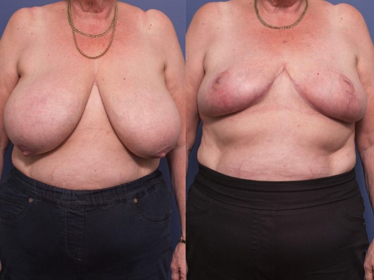Bilateral Breast Reduction 3A