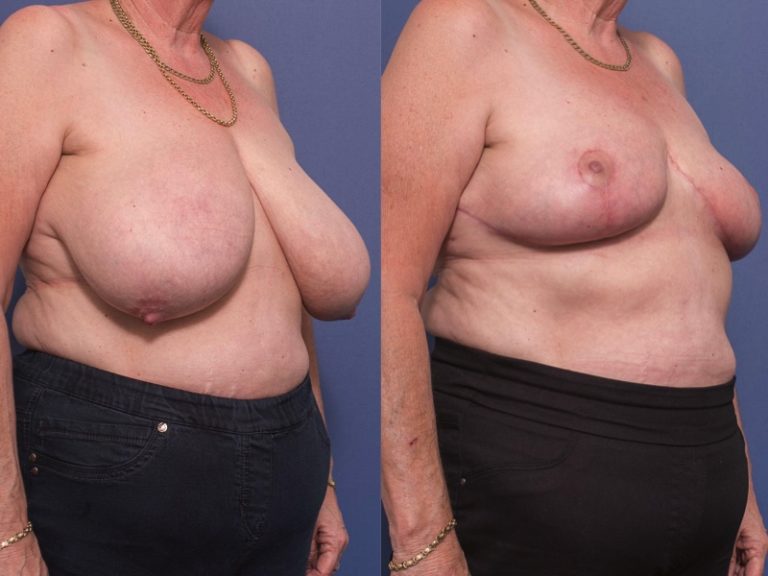 Breast Reduction patient before and after surgery 3B, Dr Peters Brisbane