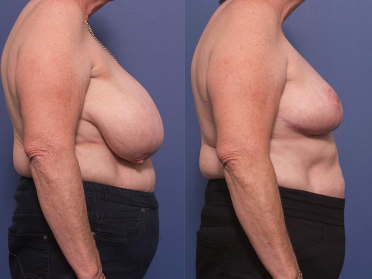 Photo of breast reduction patient before and after surgery 3C, Dr Matthew Peters