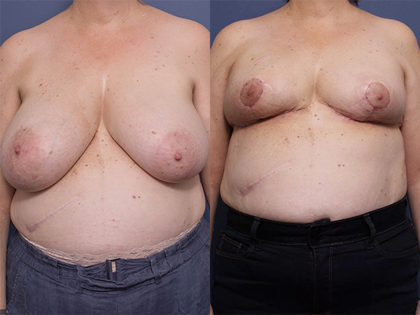 Breast Reduction Surgery BA 4A