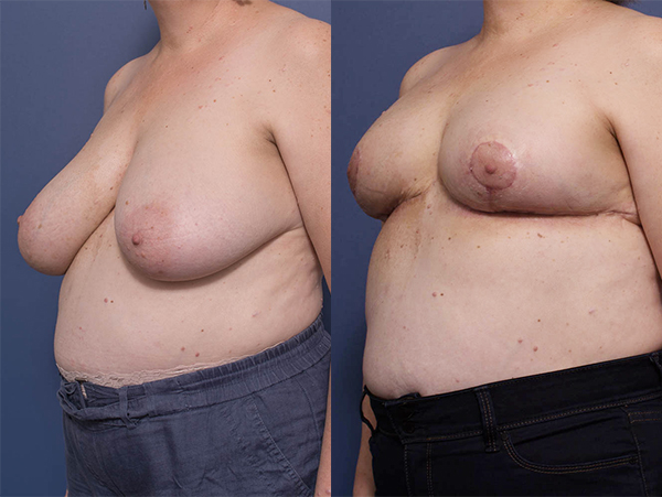 Bilateral Breast Reduction surgery, Dr Peters photo gallery 4B