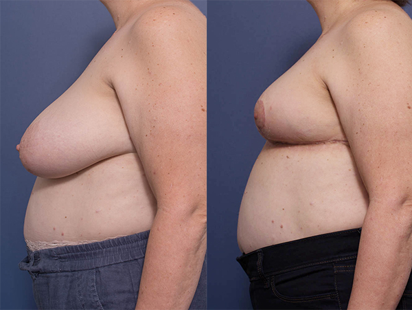Before and after breast reduction (bilateral) with Dr Peters, photo 4C