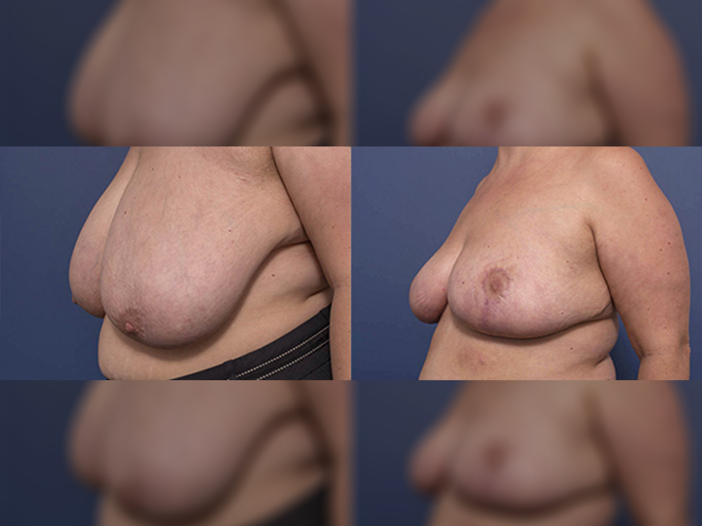 Breast Reduction on older female patient, photo 5B