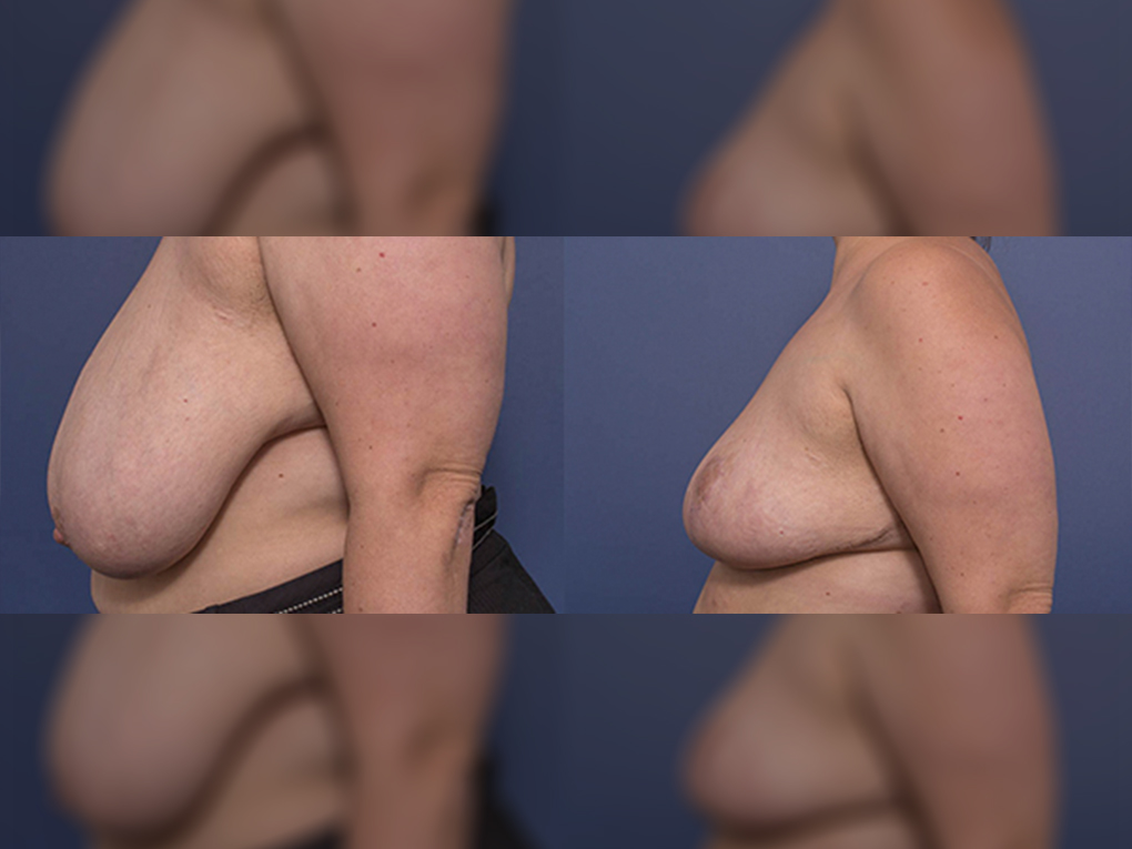 Dr Peters, Bilateral Breast Reduction 5C, Dr Peters Brisbane
