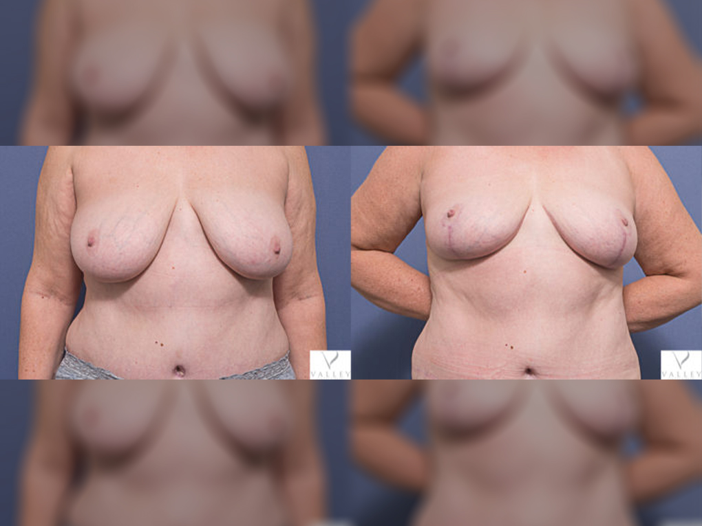 Patient before & after bilateral Breast Reduction, Dr Peters 7A