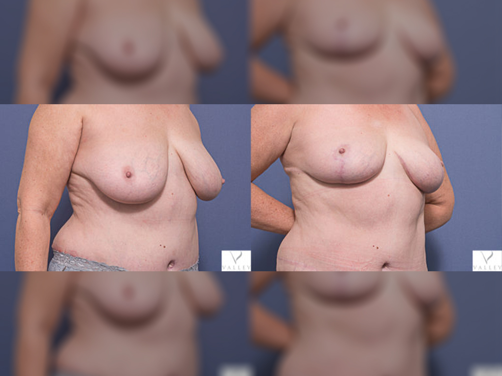 Dr Peters, Breast Reduction Surgery BA 7B