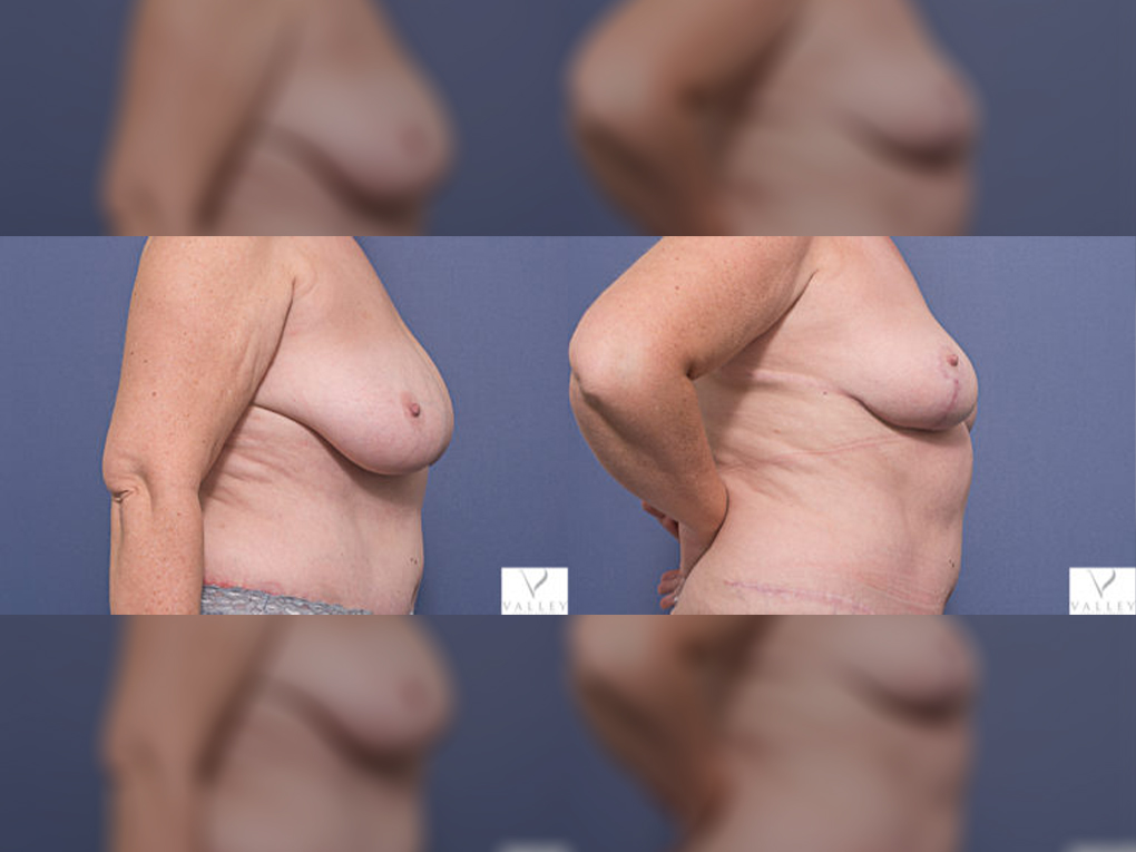 Bilateral Breast Reduction patient 7C, Dr Peters Brisbane