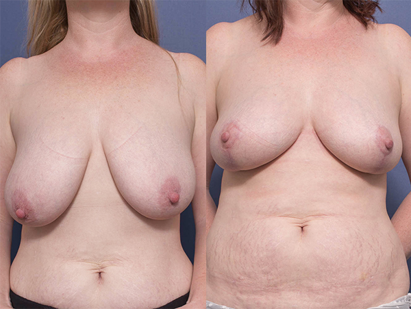 Patient before and after Bilateral Breast Reduction at Dr Peter's clinic in Brisbane 8A