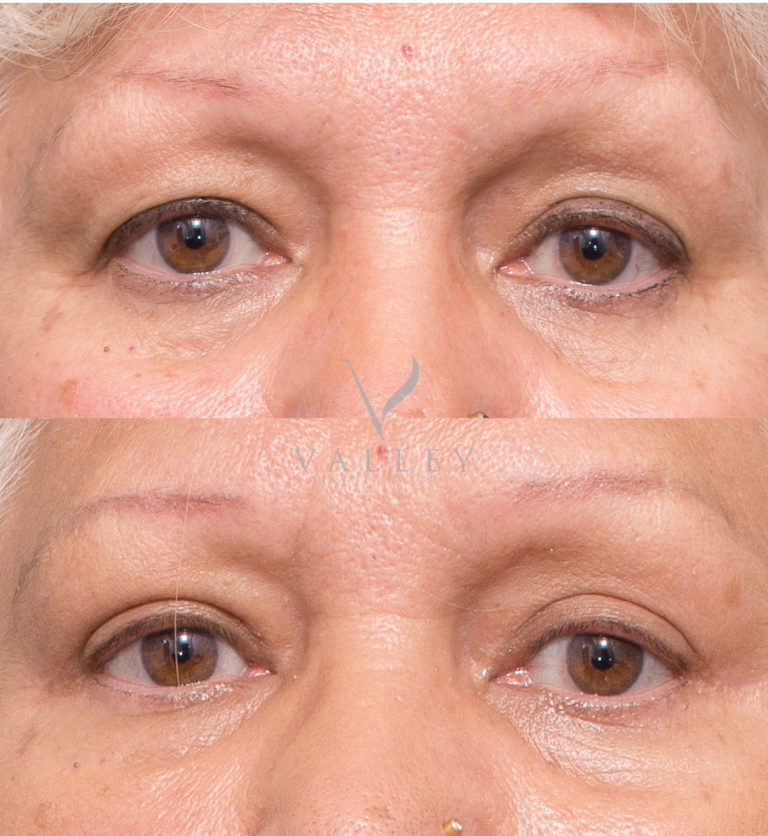 Eyelid surgery before and after 1A, Dr Peters