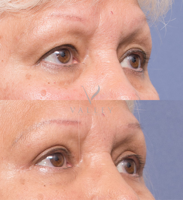 Upper Blepharoplasty 1B, before & afters, Dr Peters Brisbane