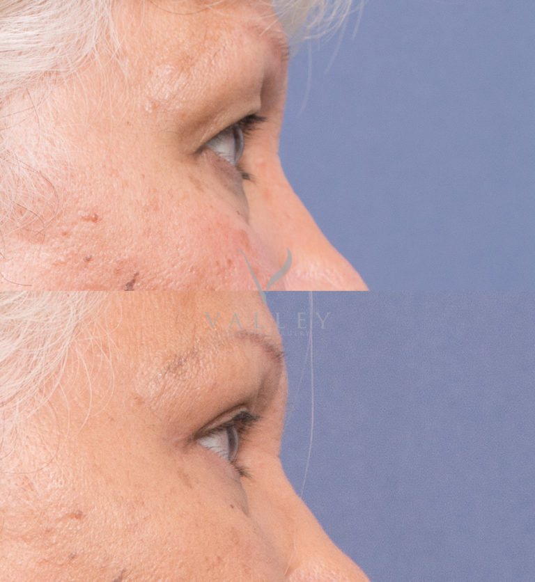 Dr Peters upper eyelid reduction surgery results 1C