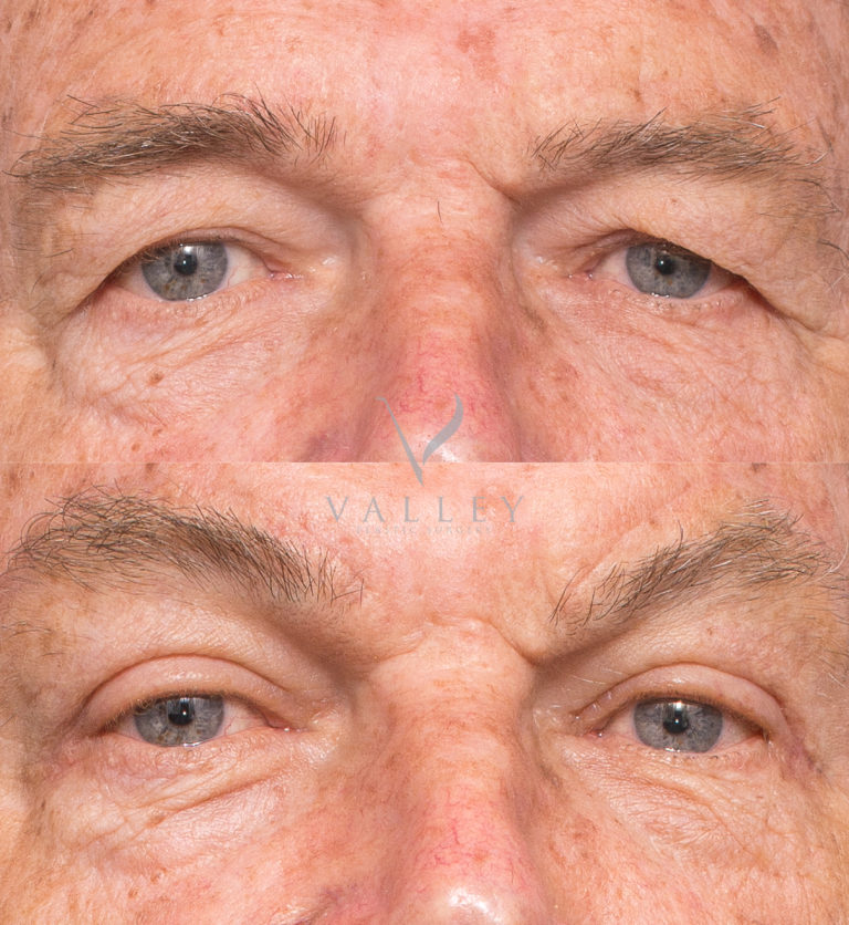 Patient before and after upper blepharoplasty, Dr Peters photo gallery 2A