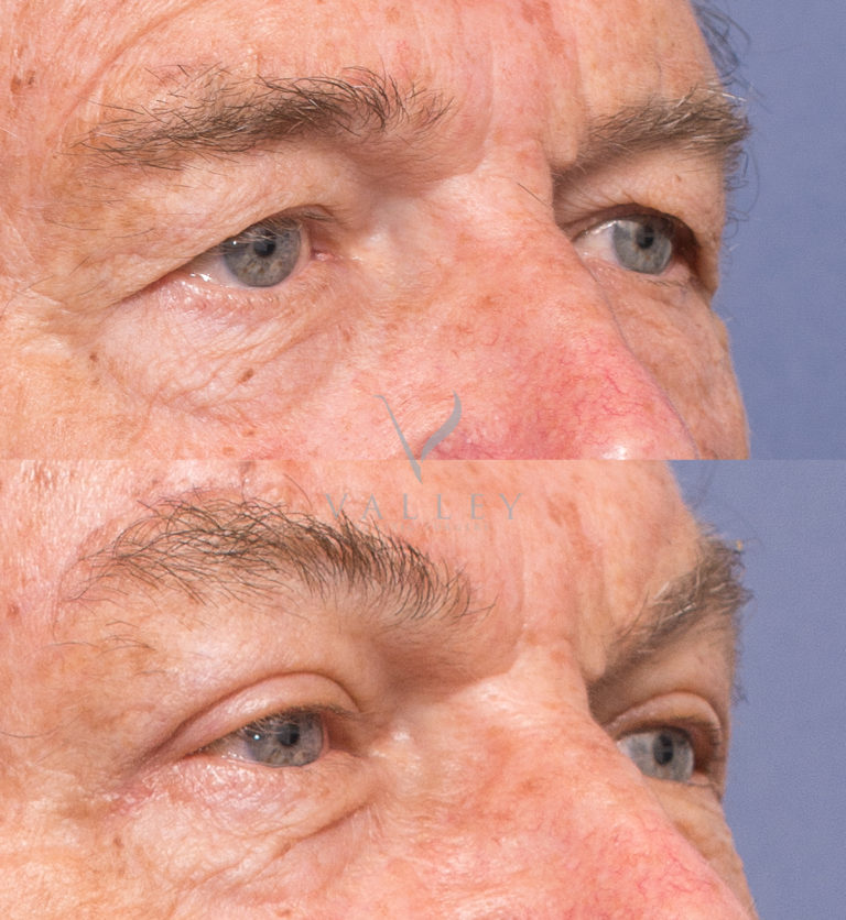 Upper Blepharoplasty before and after 2B, Dr Peters