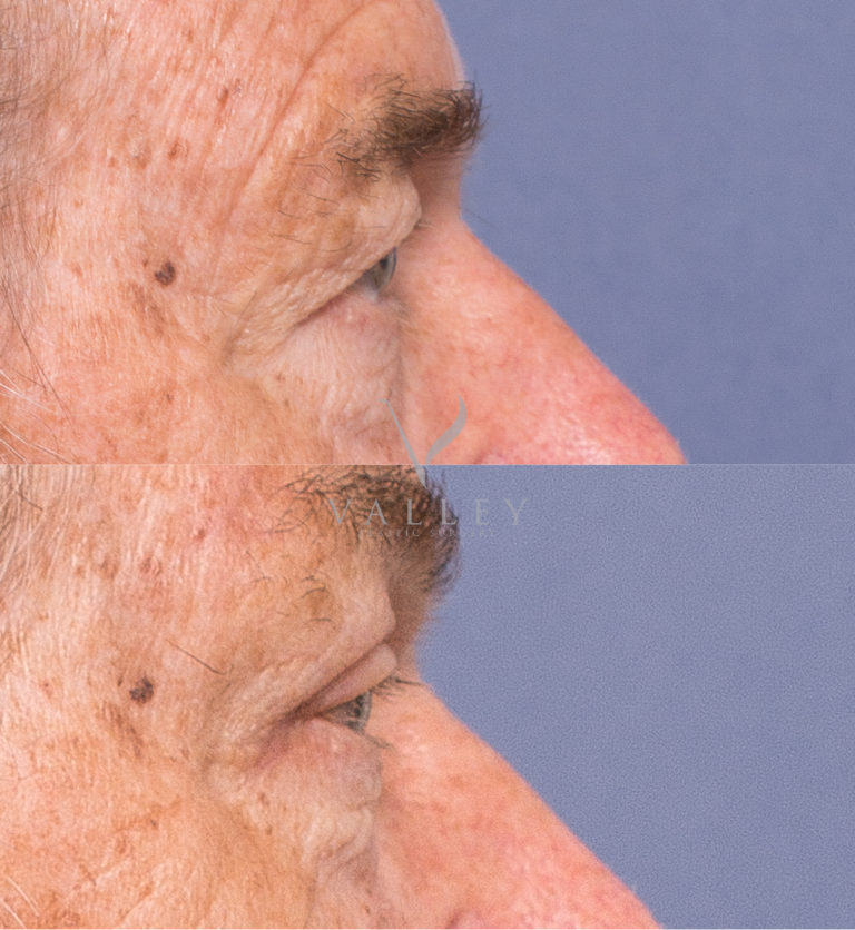 Before and afters gallery 2C, upper eyelid surgery, Dr Peters