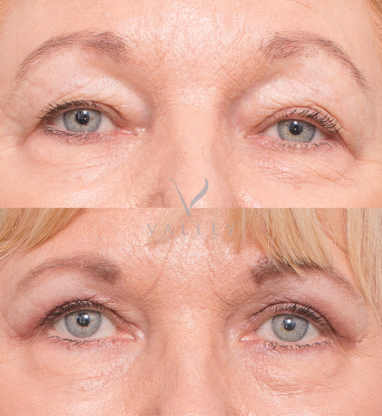 Eyelid surgery before and after 3A, Dr Peters Brisbane