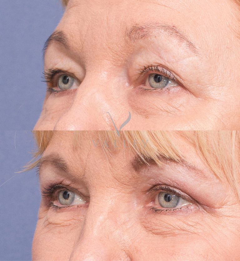 Blepharoplasty patient before and after surgery 3B, Dr Matthew Peters