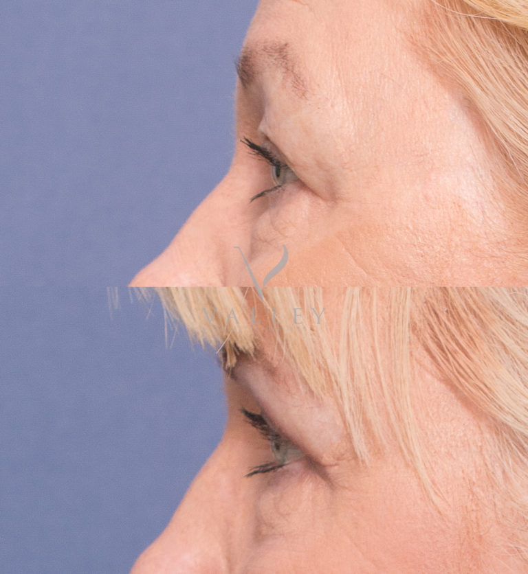 Eyelid Reduction Surgery before & afters gallery 3C