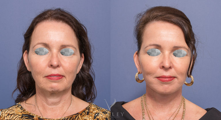 Facelift Patient 02 BA  Patient 02 before and after Facelift, Neck Lift and Bilateral Blepharoplasties