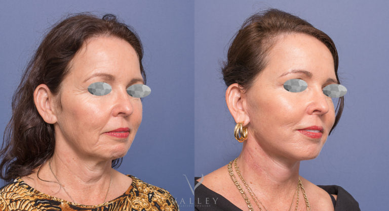 Facelift Neck Lift and Eyelid Surgery Patient 02 BA Face Lift & Neck Lift patient 02, before & afters, Dr Peters