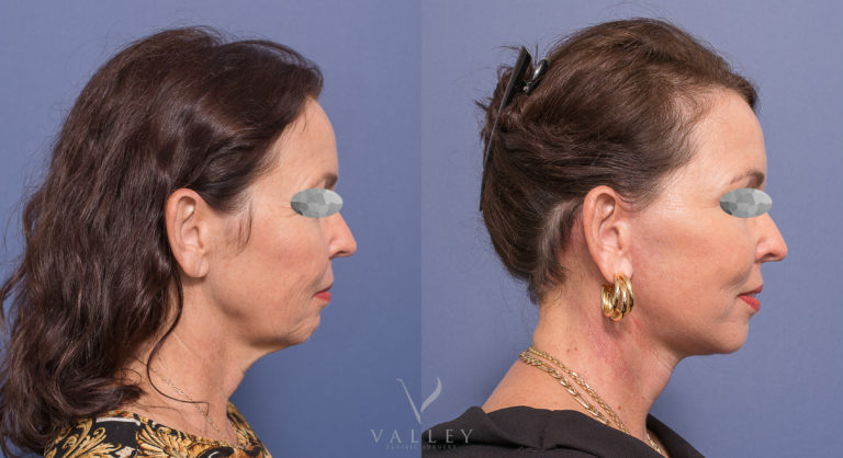Facelift Patient 02-3 BA  Facelift, Neck Lift and Blepharoplasty before & after 02-3, Dr Peters Brisbane QLD
