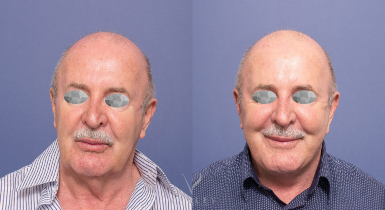 Male Facelift and Neck Lift BA 03 Male Facelift and Neck Lift 03, Dr Peters