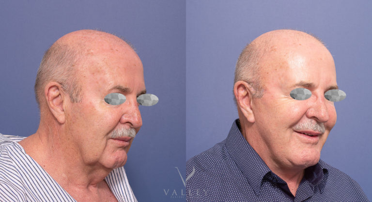 Male Face and Neck Lift Patient 03-2 Male Face and Neck Lift before & after 03-2
