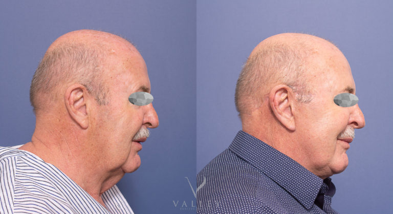 Facelift and Neck Lift Patient 03-3 Male Facelift and Neck Lift 03-3, male patient, side view
