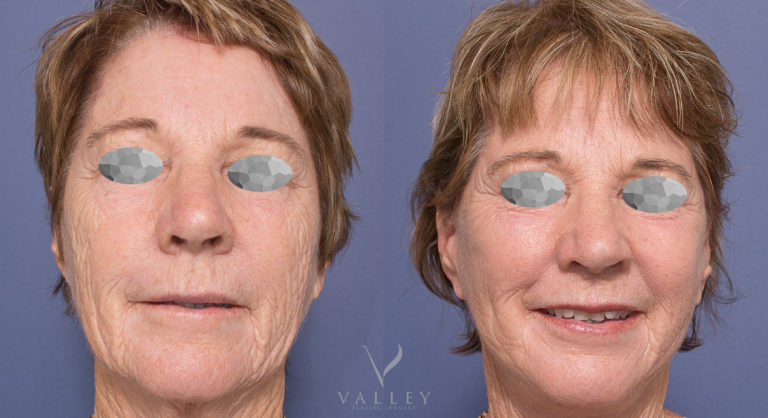 Facelift and Neck Lift Patient 04 BA Patient 04 before & after Facelift & Neck Lift surgery with Dr Peters