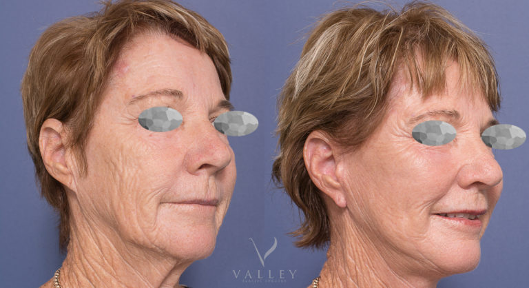 Facelift and Neck Lift Patient BA 04-2 Face lift and neck lift, patient before & after surgery, photo 04-2