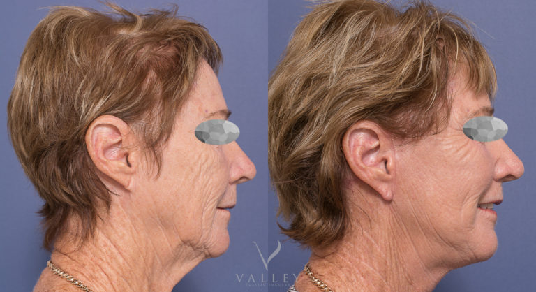 Dr Peters Facelift Surgery Patient 04-3 BA Patient 04-3 before & after facelift and neck lift surgery at Dr Peters clinic in Brisbane