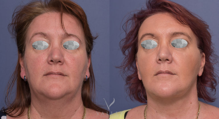 Face and Neck Lift Patient BA 05 Face and Neck Lift before & after 05-1, front view, Dr Peters