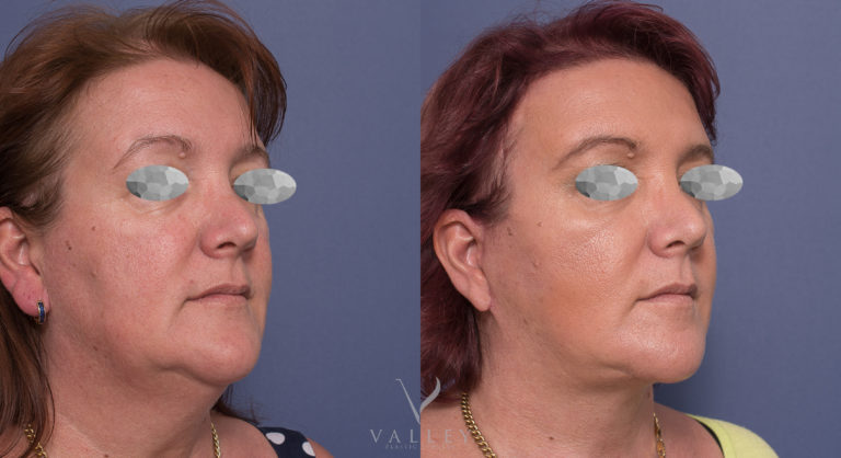 Facelift Surgery Patient BA 05-2  Facelift surgery with Dr Peters, before & after gallery 05-2, angle view