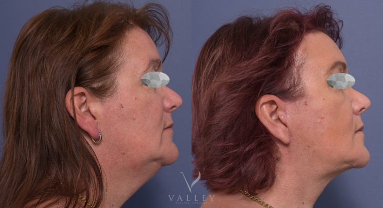 Face and Neck Lift Patient BA 05-3 Face and Neck Lift 05-3, Dr Peters, Brisbane QLD