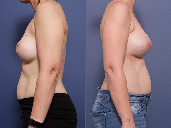 Breast Implant Revision before and after 1C, Dr Peters Brisbane QLD
