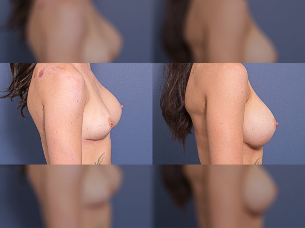 Breast Revision patient before and after surgery 2C