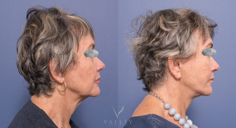 Facelift Surgery BA 01-3 Patient before & after facelift with Dr Peters, photo 01-3, side view