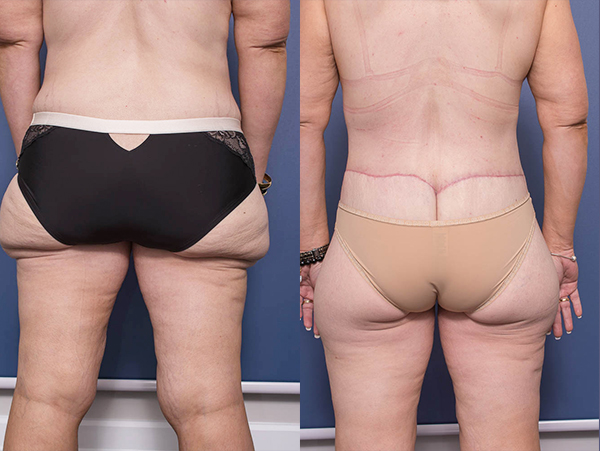 Body Lift surgery before and after 1D, tummy tuck, breast lift and back lipectomy