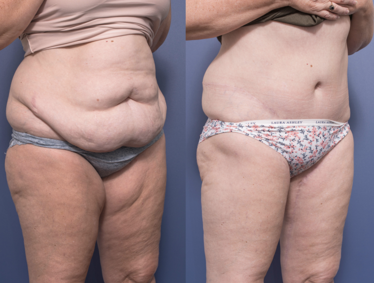Body Lift Surgery - Medial Thigh Lift and Belt Lipectomy, Dr Peters, Brisbane QLD