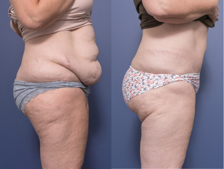 Body Lift before and after, Dr Peters, photo 3C