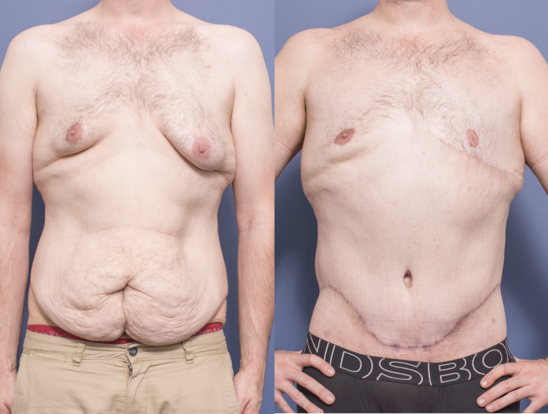 Male Body Lift Surgery before and after 4A, Dr Peters