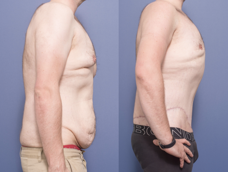 Gynecomastia & Belt Lipectomy, before & after 4C, Dr Peters Brisbane